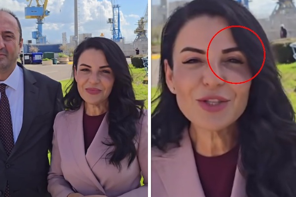 Zv.kryeministrja shfaqet me sy të nxirë, çfarë po ndodh me Ballukun?